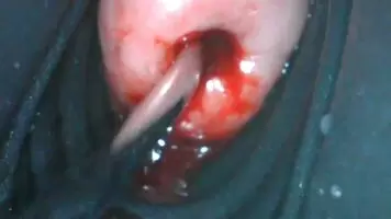 want an extreme close-up? 😂 endoscope view of sounding my menstruating cervix