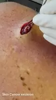 Skin cancer excision